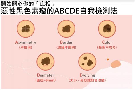 臉突然長痣|不只臉上 7成「索命痣」長在你不注意的地方 5種痣快。